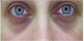 Мешки под глазами. Причины патологии. Как убрать мешки под глазами в домашних условиях?