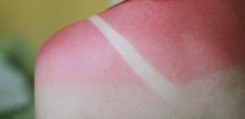 Солнечный ожог. Причины, симптомы, профилактика и лечение