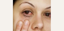 Красные глаза - причины красных глаз, диагностика причин, лечение патологии