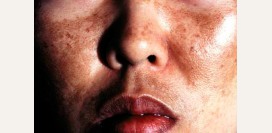 Болезнь Аддисона. Причины, симптомы, диагностика и лечение патологии