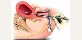 Диагностическое выскабливание матки. Показания, противопоказания, методика. Как подготовиться к диагностике и что делать после нее?