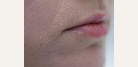 Шелушится кожа на лице. Причины шелушения кожи на лице у мужчин и женщин. Что делать, если шелушится кожа на лице