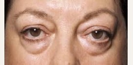 Мешки под глазами. Причины появления мешков под глазами. Как избавиться от мешков под глазами?