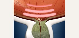 Закрытоугольная глаукома. Причины, симптомы, диагностика, лечение и профилактика заболевания.