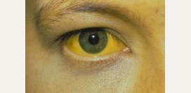 Желтые глаза. Причины желтизны белков глаз, диагностика причин, лечение патологий