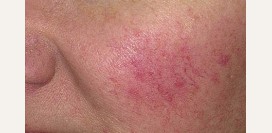 Розацеа (розовые угри). Причины, диагностика и лечение патологии