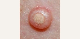 Контагиозный моллюск. Причины, симптомы, диагностика и лечение патологии