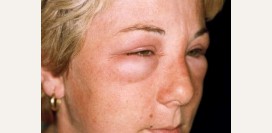 Нефротический синдром. Причины, симптомы, диагностика и лечение патологии