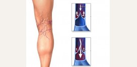 Варикозное расширение вен - варикоз. Причины, факторы риска, диагностика, эффективное лечение болезни.