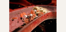 Атеросклероз - причины, факторы риска, осложнения и профилактика болезни