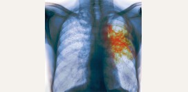 Туберкулез. Причины, симптомы, современная диагностика и эффективное лечение