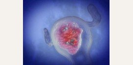 Миома матки - причины, симптомы, диагностика и лечение без операции. Эмболизация маточных артерий, какова доза облучения, возможна ли беременность после нее? 