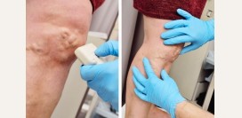 Флеболог. Чем занимается данный специалист, какие исследования проводит, какие патологии лечит?