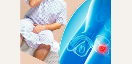 Потребление насыщенных жиров приводит к развитию агрессивного рака простаты