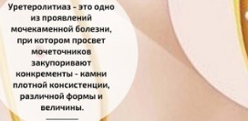 Камни мочеточника (уретеролитиаз) - причины, симптомы, диагностика и лечение уретеролитиаза