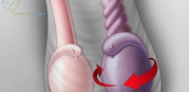 Перекрут яичка. Причины, симптомы, диагностика и лечение патологии