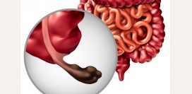 Удаление аппендикса снижает риск развития болезни Паркинсона