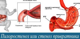 Пилоростеноз (стеноз привратника). Причин, симптомы, диагностика и лечение патологии