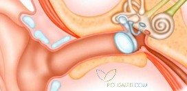 Отосклероз. Причины, симптомы, диагностика, профилактика и лечение патологии