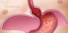 Грыжа пищеводного отверстия диафрагмы (хиатальная грыжа). Причины, симптомы, диагностика и лечение патологии