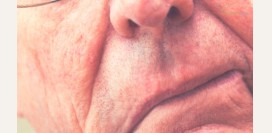 Учимся распознавать первые признаки инсульта и оказывать первую помощь