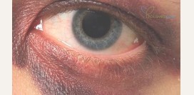 Как быстро убрать синяк под глазом и на теле в домашних условиях?