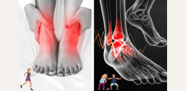 Артрит голеностопного сустава. Симптомы, диагностика и лечение патологии