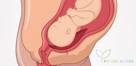 Предлежание плаценты. Причины, признаки, классификация, последствия, диагностика и лечение патологии. Как подготовиться к родам? Как лучше рожать? Что нельзя делать при данном состоянии?