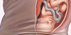 Обвитие пуповины. Причины, виды, признаки, последствия патологии. Чем опасно данное состояние? Как рожать, если плод «запутался» в пуповине? Можно ли «распутать»?