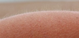 Гусиная кожа – фолликулярный кератоз – если пупырышки не проходят