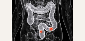 Рак толстой кишки - причины, симптомы, современная диагностика и эффективное лечение