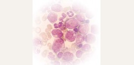 Лейкоз - причины, факторы риска, симптомы, диагностика и лечение