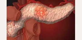 Панкреатит - причины, симптомы, современная диагностика, лечение и диета