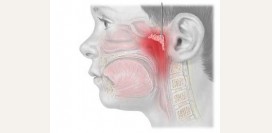 Аденоиды. Симптомы, причины воспаления, лечение и удаление аденоидов.