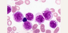 Миелобластный лейкоз – причины, симптомы, лечение и прогноз