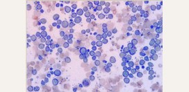 Лимфосаркома – причины, симптомы, лечение и прогноз