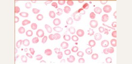 Дефект мембраны эритроцитов: микроцитоз, овалоцитоз, акантоцитоз – причины, симптомы и лечение