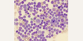 Хронический лимфолейкоз – симптомы, причины, лечение, прогноз.