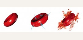 Гемолитическая анемия - аутоиммунная, приобретенная, врожденные