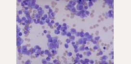 Миеломная болезнь (плазмоцитома) – причины, симптомы, диагностика, лечение и прогноз