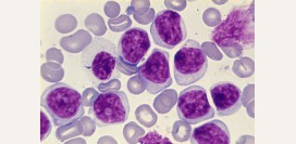 Хронический миелолейкоз - причины, симптомы, диагностика, лечение и прогноз