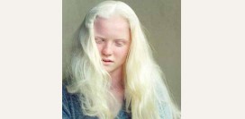 Фенилкетонурия (ФКУ) - причины, симптомы, диагностика и лечение фенилкетонурии: диета и питание