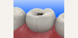 Кариес – лечение и профилактика. Кариес молочных зубов. Причины, симптомы и диагностика кариеса 