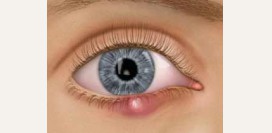 Халязион верхнего и нижнего века. Как выглядит халязион – фото. Причины, симптомы, диагностика. Операция по удалению халязиона