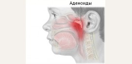 Аденоиды –  причины, симптомы, степени, диагностика и лечение. Где находятся аденоиды, почему они воспаляются?