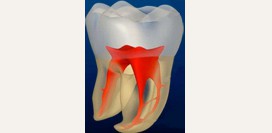Пульпит острый и хронический - причины, симптомы, диагностика, осложнения и лечение пульпита. Виды пульпита: фибринозный, гангренозный, гнойный, гипертрофический