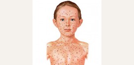 Краснуха у детей и беременных. Вирус краснухи – как развивается болезнь. Осложнения, симптомы и профилактика болезни. Краснуха при беременности – возможные осложнения