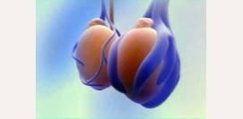 Варикоцеле – причины, симптомы, диагностика. Лечение патологии: показания к операции, подготовка, виды операции, после операции. Возможные осложнения после операции: боли, отек, швы