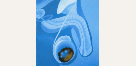 Эпидидимит – острый и хронический. Причины, симптомы, диагностика и лечение