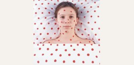 Краснуха - симптомы, признаки, лечение, последствия и профилактика. Прививка – сроки, эффективность, делать ли прививку